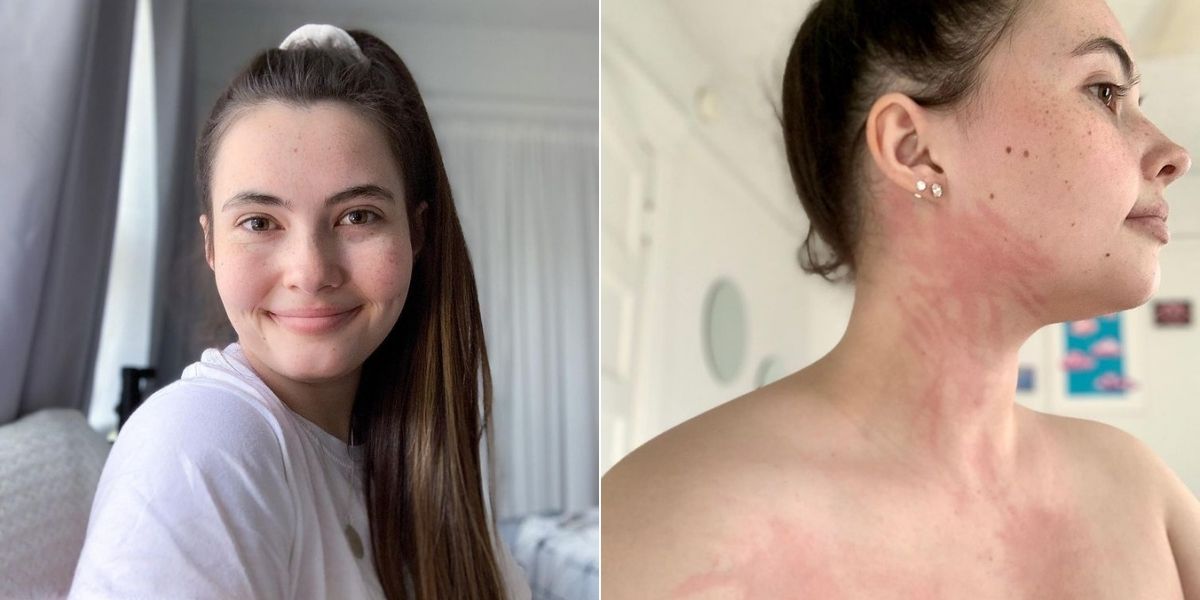 Tessa Hansen: the young woman who is allergic to water, including her own  tears